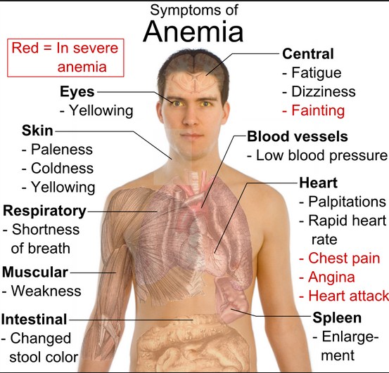 Understanding Anemia -- Symptoms		